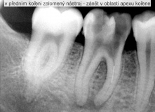 endodoncie - zalomený nástroj v kořenovém kanálku před a po