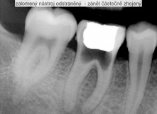 endodoncie - zalomený nástroj v kořenovém kanálku před a po