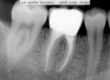 endodoncie - zalomený nástroj v kořenovém kanálku před a po