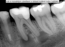 zub s rozsáhlým zánět v oblasti kořene - endodoncie - léčba - před a po