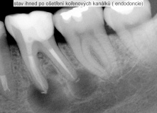 zub s rozsáhlým zánět v oblasti kořene - endodoncie - léčba - před a po