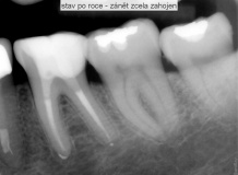 zub s rozsáhlým zánět v oblasti kořene - endodoncie - léčba - před a po